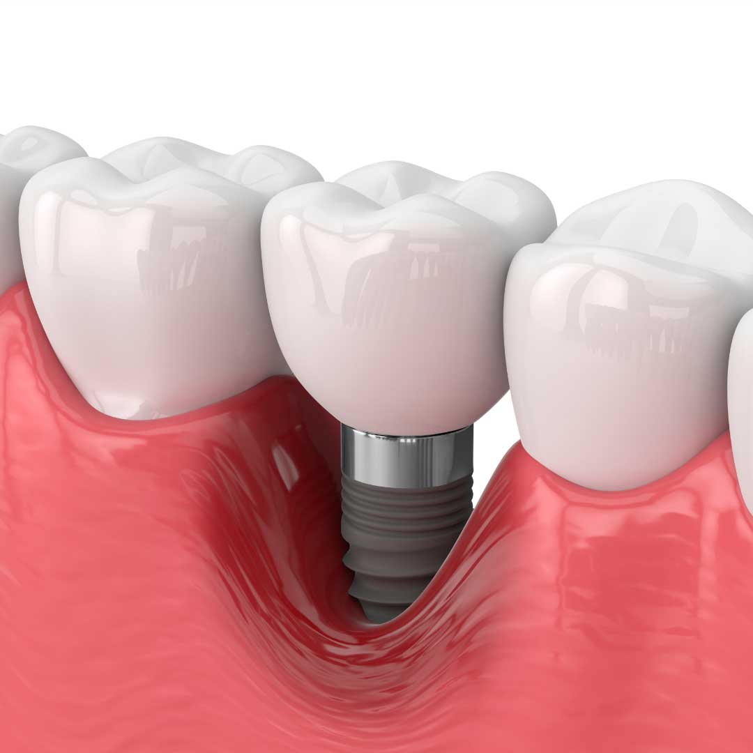 Periimplantitis C Mo Prevenirlo Detectarlo Y Tratarlo Cl Nica