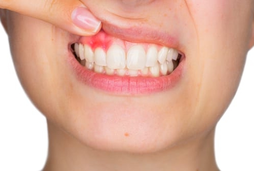 Causas y tratamiento de la gingivitis.