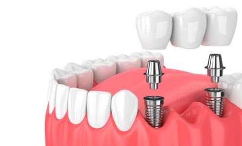 Tipos de implantes dentales