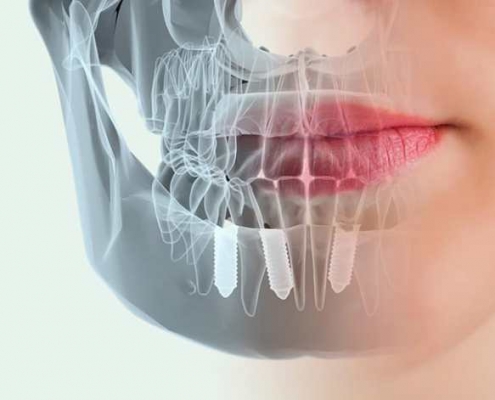 Tipos de implantes dentales