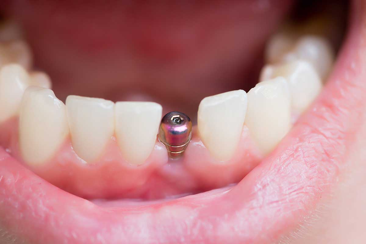 impaciente Derecho Mucama Todo sobre los implantes dentales - Clínica Dental en Toledo