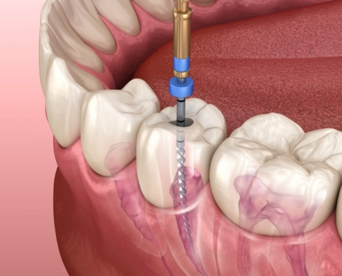 endodoncia