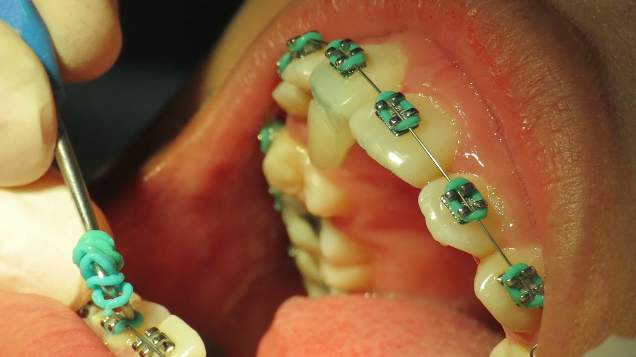 ¿El ajuste de brackets duele? Clínica Dental en Toledo