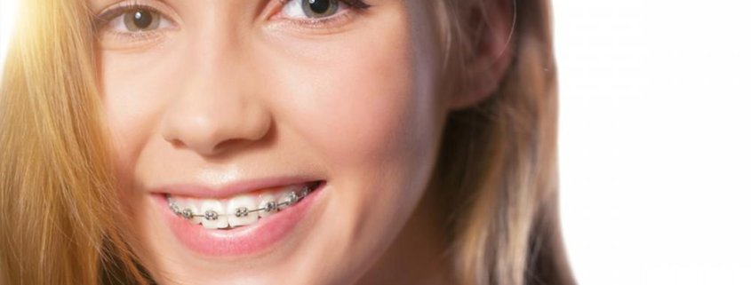 Duración del tratamiento de ortodoncia