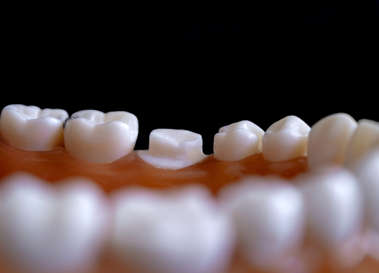 Fundas Dentales Fijas Para Qu Se Utilizan Cl Nica Dental En Toledo