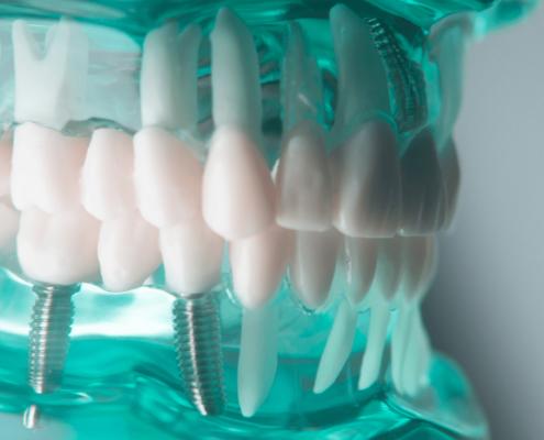 Tipos de implantes dentales de titanio