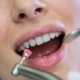Limpieza dental profesional
