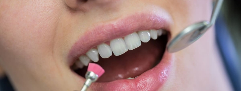 Limpieza dental profesional